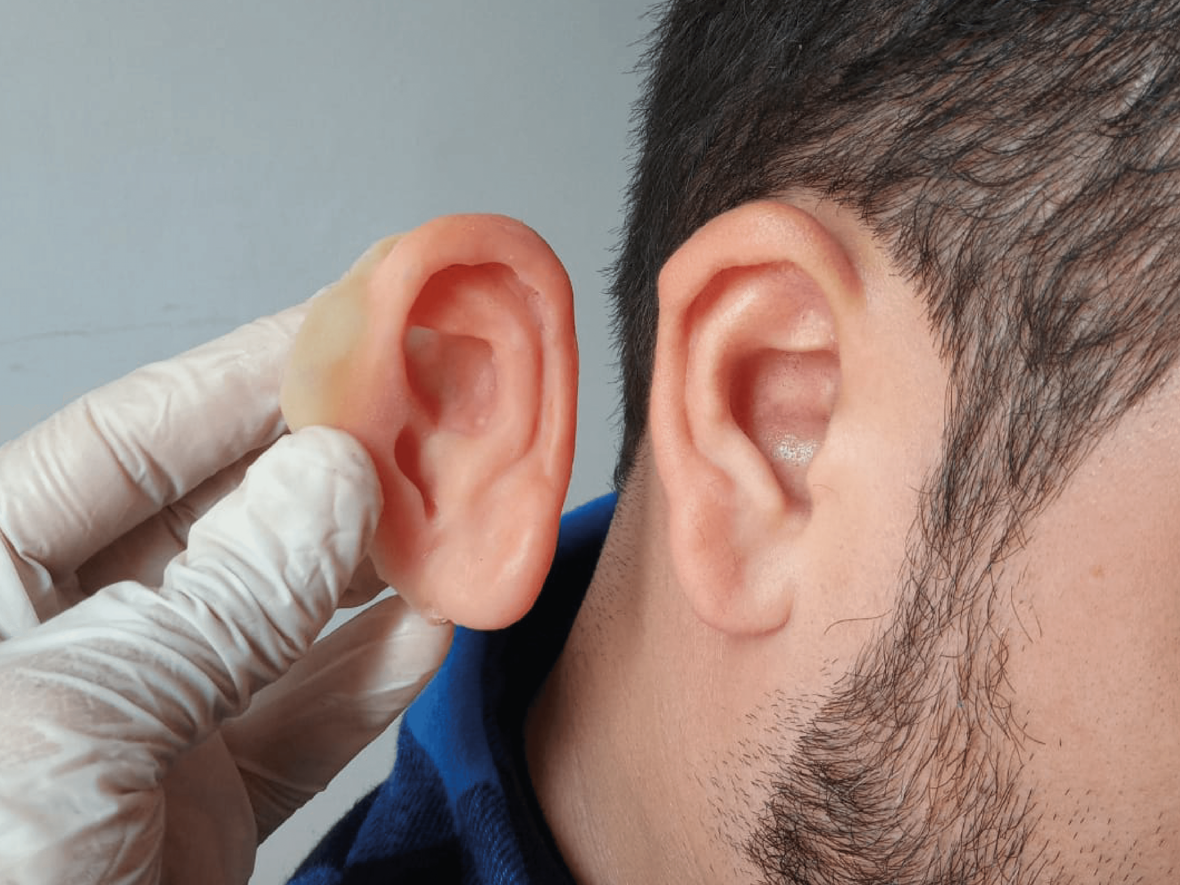 Prótesis de microtia